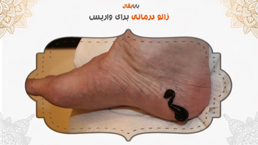 زالو درمانی برای واریس