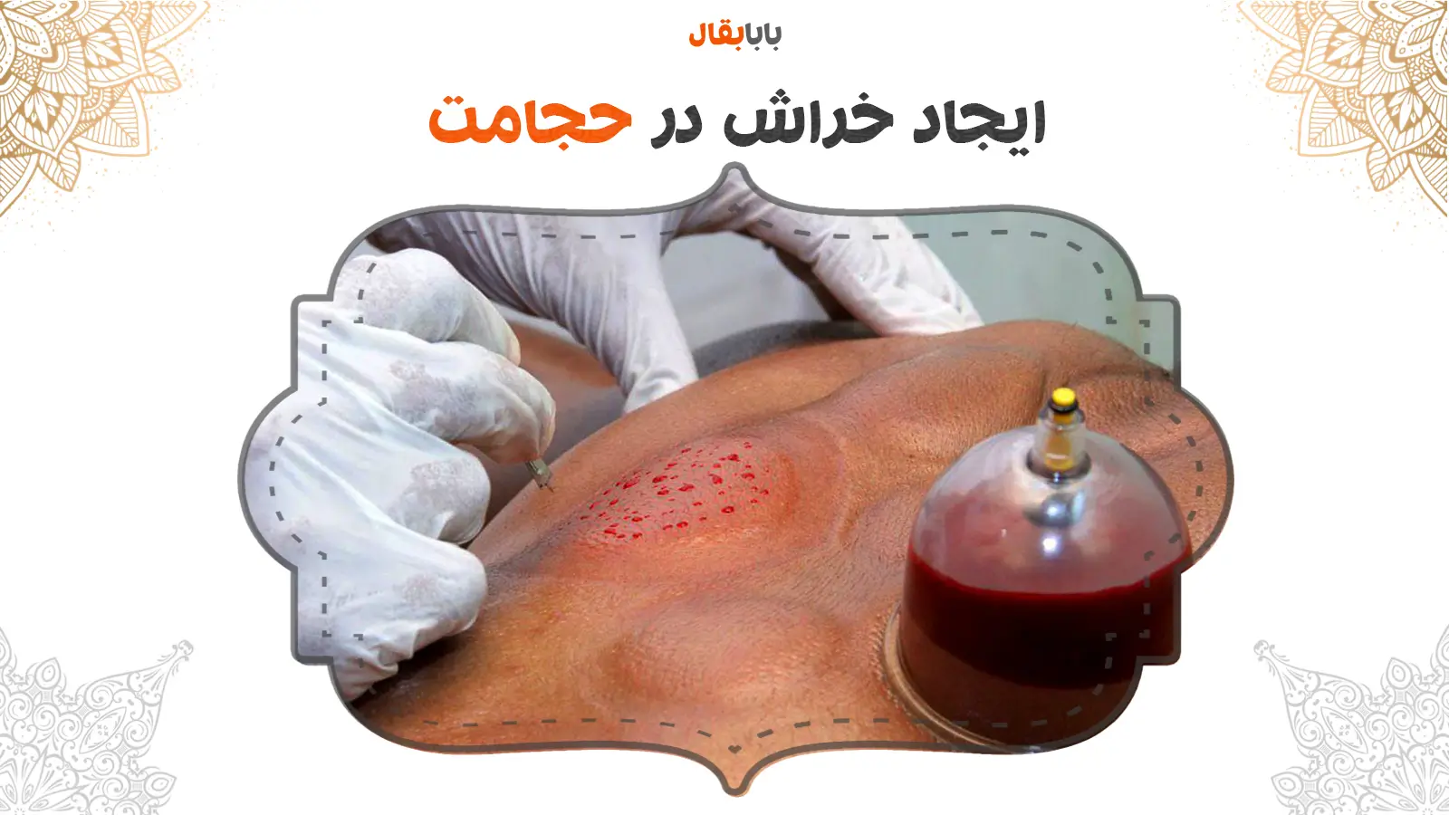 خراش در حجامت